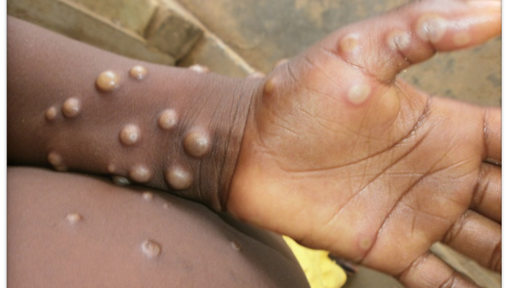 facts about the monkeypox virus
