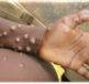 facts about the monkeypox virus